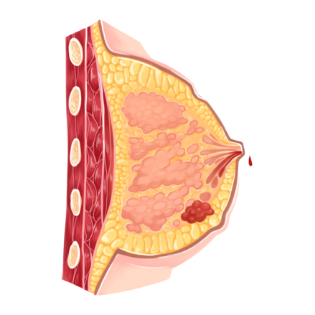 유방암을 나타내는 그래픽 이미지
