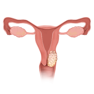자궁경부암을 나타내는 그래픽 이미지