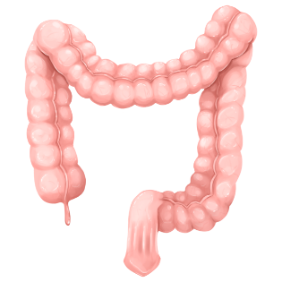 대장암을 나타내는 그래픽 이미지