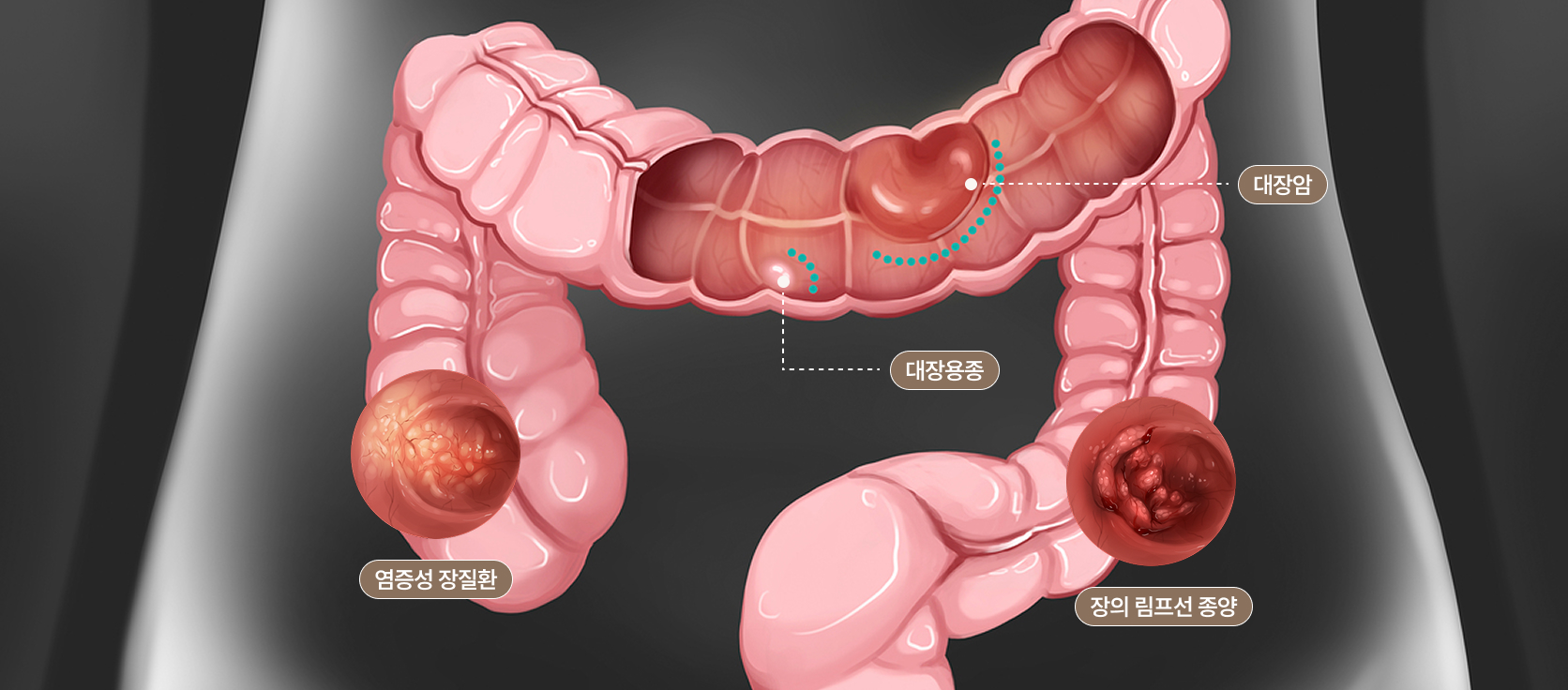각종 대장 질환이 발생하는 위치를 나타내는 그래픽 이미지