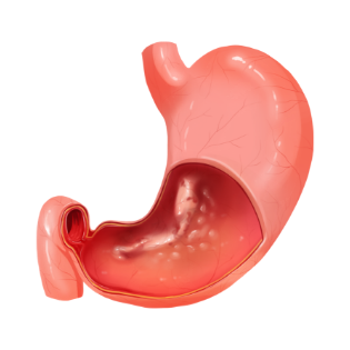 위암을 나타내는 그래픽 이미지