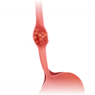 식도암을 나타내는 그래픽 이미지