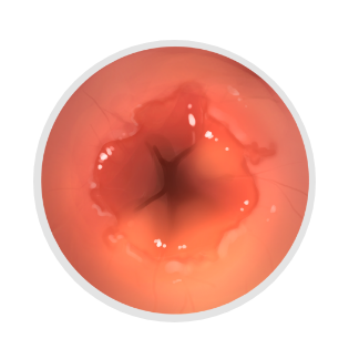 식도염을 나타내는 그래픽 이미지