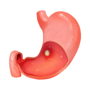 위·십이지장궤양을 나타내는 그래픽 이미지